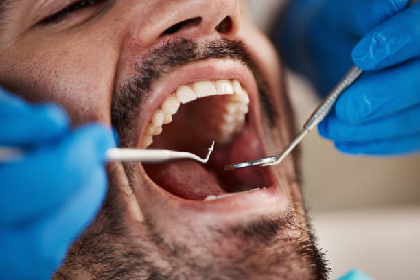 Best Emergency Tooth Extraction in Dunbar, WV