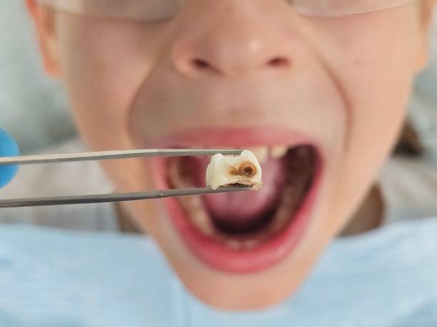 Best Emergency Tooth Extraction in Dunbar, WV