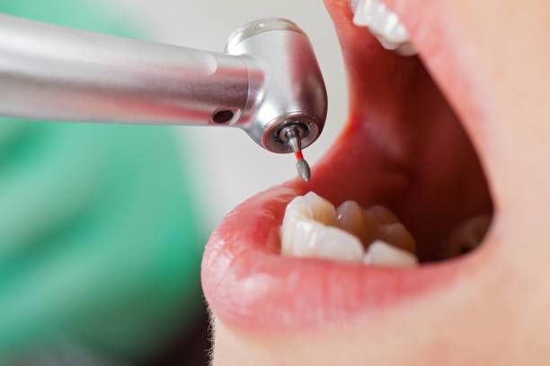 Best Emergency Wisdom Teeth Removal in Dunbar, WV